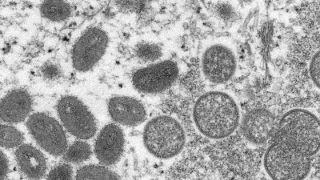 Exame laboratorial confirma segundo caso de varíola dos macacos no Rio Grande do Sul
