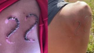 Jovem usa ferro em brasa para marcar 22 de Bolsonaro na pele