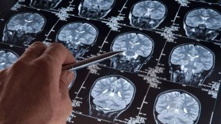 Vírus podem estar por trás do Alzheimer, alerta estudo