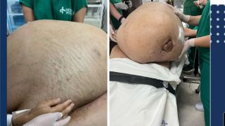 Mulher começa a ganhar peso, vai ao médico e descobre tumor de 46kg