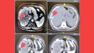 Tratamento contra câncer destrói tumor em 4 minutos em SP